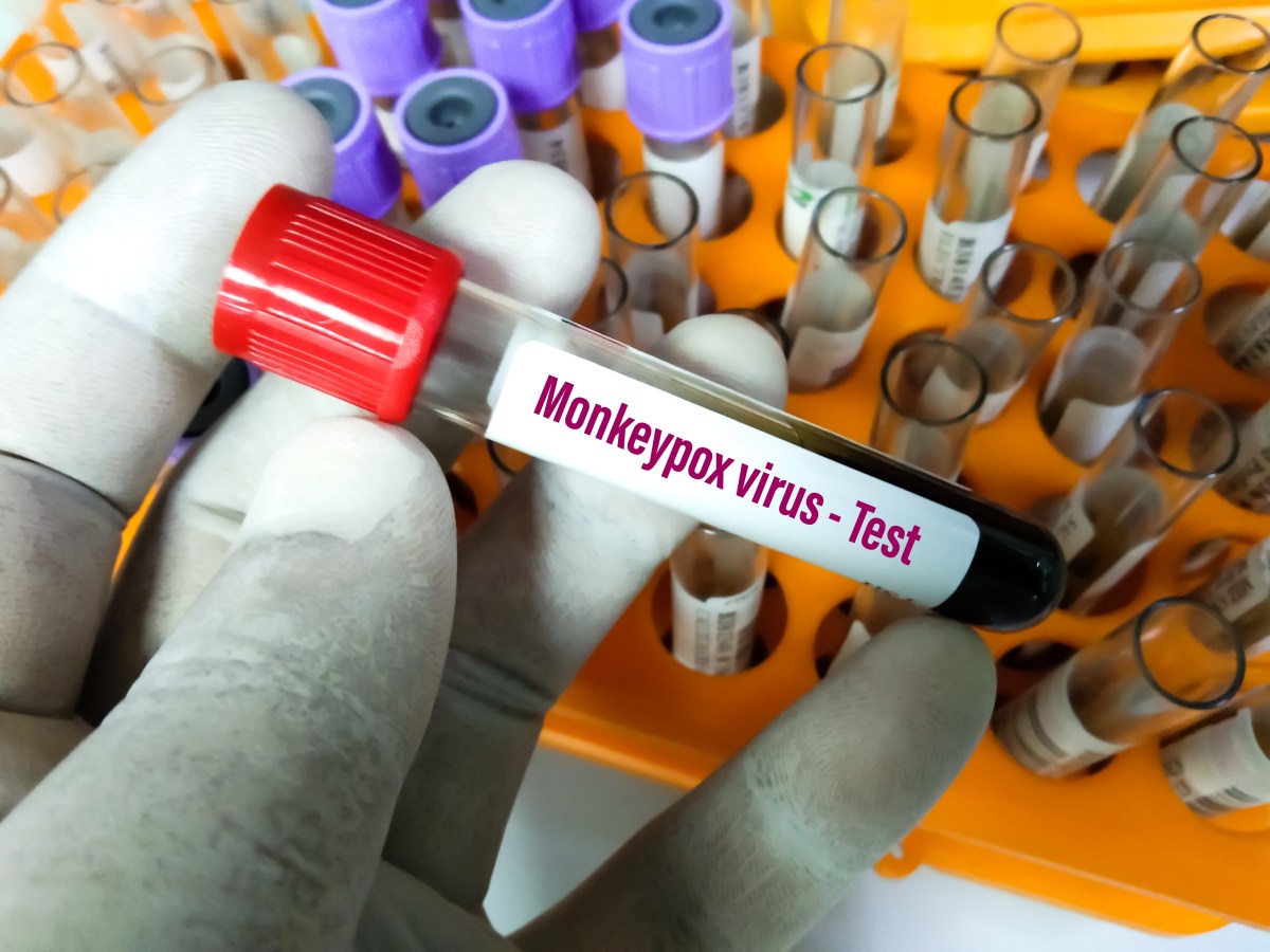 As monkeypox infections spread, social stigma concerns increase | blood vial