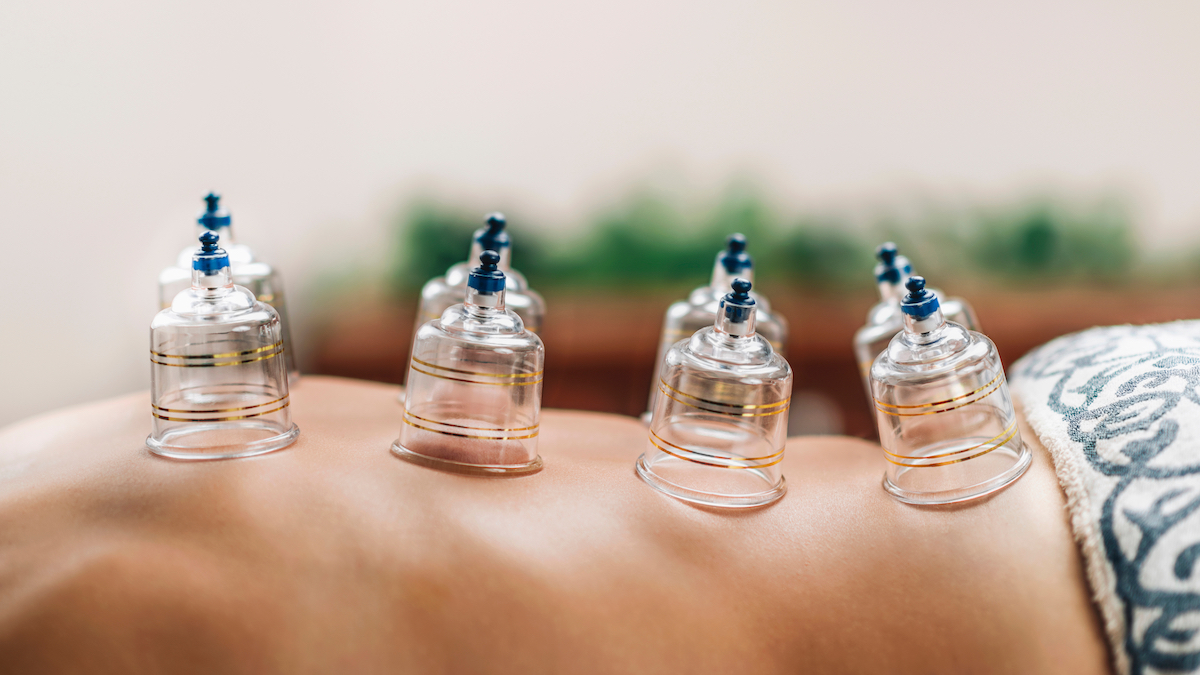 cupping treatment
